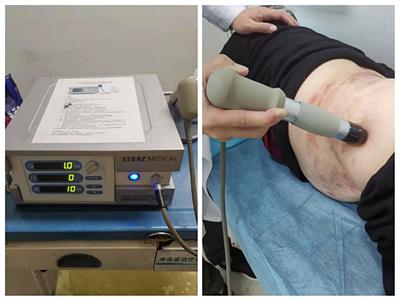 Effect and safety of extracorporeal shockwave therapy for postherpetic neuralgia: A randomized single-blind clinical study